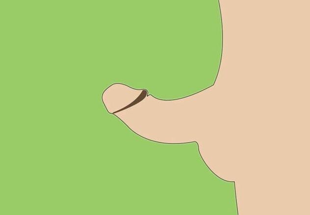 zakřivení penisu jako indikace k chirurgickému zvětšení